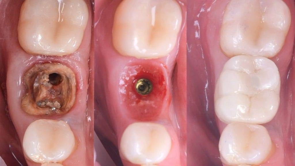 punte dentara